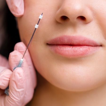 Thread Lift 101: The Beginner’s Guide to the “Lunchtime Facelift”